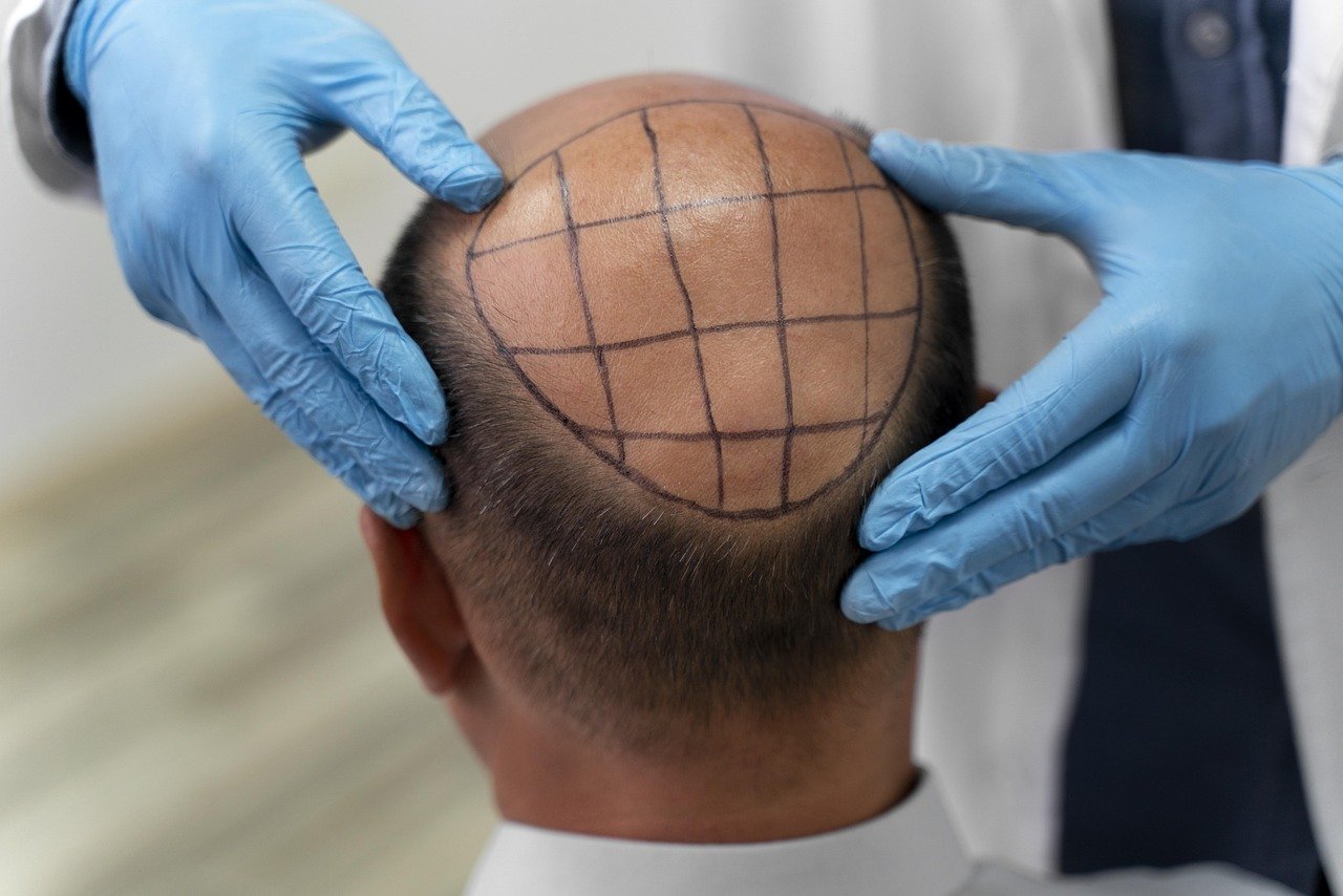 Affordable Hair Transplant In India: Restoring Confidence